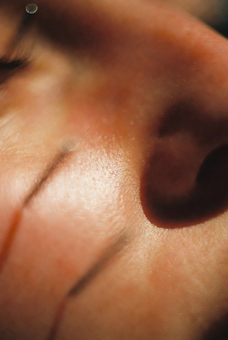 Holistic Microneedling: Why We Start With Acupuncture