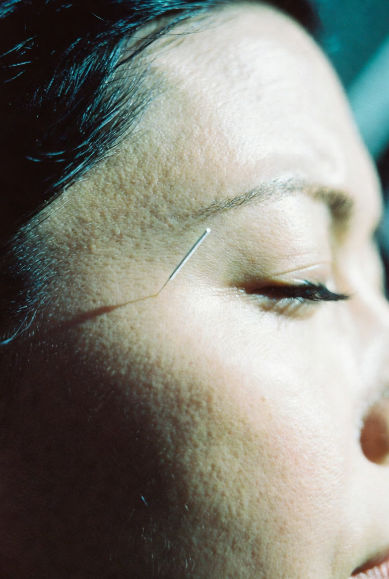 Acupuncture for Headaches and Migraines: A TCM Perspective