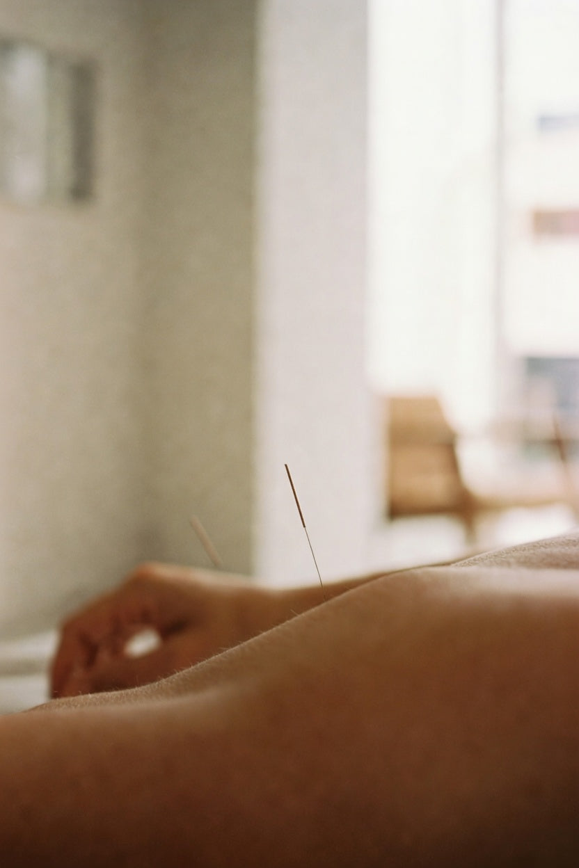 Acupuncture for Anxiety and Stress: A Gentler Way Through