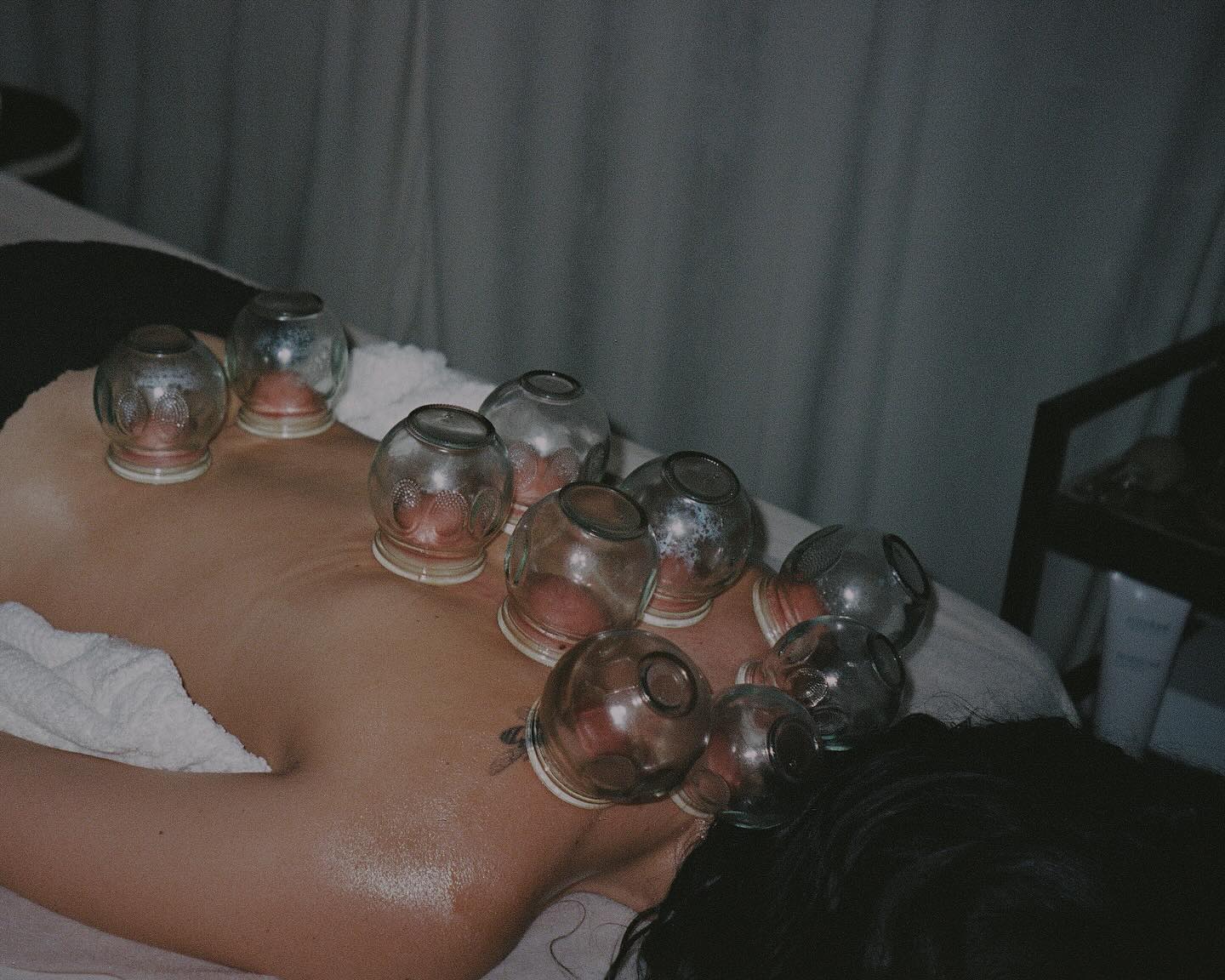 Cupping Therapy in Phoenix: What the Marks Mean and Why It Works